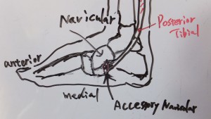 Accessory navicular 1