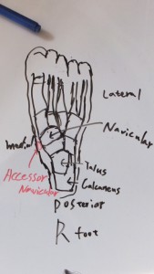 Accessory navicular 2